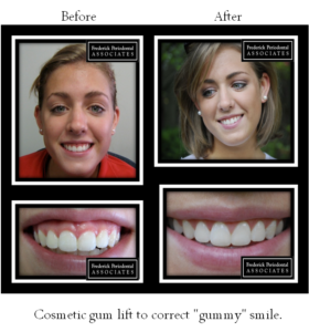Before and after corrected gymmy smile